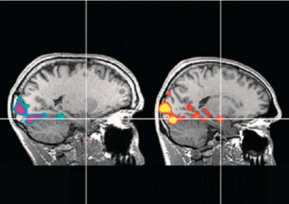 Keine Angst. Scans vergleichen Honnolds Gehirn (links) mit dem eines Kontrollprobanden (rechts), ein Felskletterer in ähnlichem Alter. Das Fadenkreuz markiert die Amygdala, eine Gruppe von Kernen, die am Erzeugen von Angst beteiligt sind. Während beide Kletterer dieselben verstörenden Bilder ansehen, leuchtet die Amygdala des Kontrollprobanden auf, die von Honnold bleibt träge und zeigt keinerlei Aktivität.